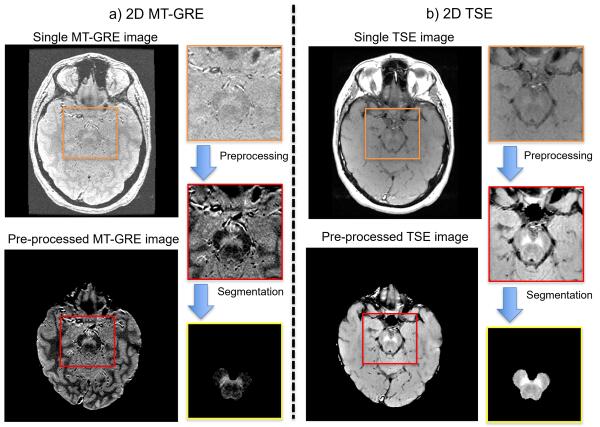 Representative MT-GRE (left) and TSE (right) images. Input panels show one of five scans; processed panels combine all five. Bottom panels are LEAP-derived midbrain-masked images, not SN segmentations.