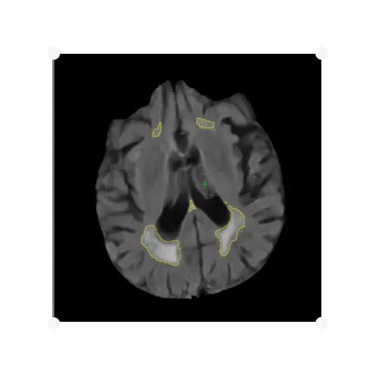 White Matter Hyperintensities (WMH)